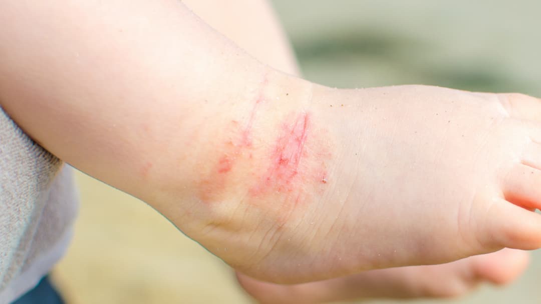 https://bng-sg.b-cdn.net/Ceradan/ChildBaby-eczema-rash-on-feet.jpg